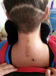 15 days post-surgical scar… And of course my poor shaved head growing in:-)