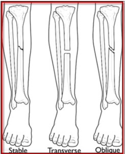 Tibial Fractures